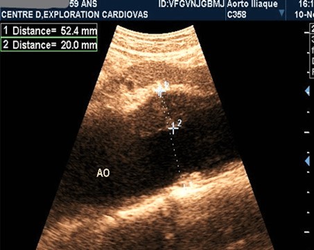Partially thrombosed 5.2cm                  fusiform suprarenal AAA with extension to the superior mesenteric artery in a 59-year-old subject (CEC 'Saint-Esprit' of the AMP-MCV).