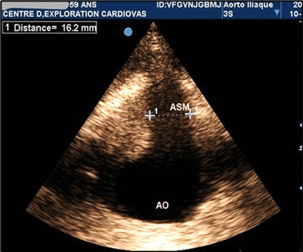 Partially thrombosed 5.2cm                  fusiform suprarenal AAA with extension to the superior mesenteric artery in a  59-year-old                   subject (CEC 'Saint-Esprit' of the AMP-MCV).