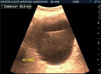 Large fusiform subrenal abdominal    aortic aneurysm of 9.28cm thrombosed at 4/5 in an 82-year-old woman (CEC                     ‘Saint-Esprit’ from AMP-MCV).