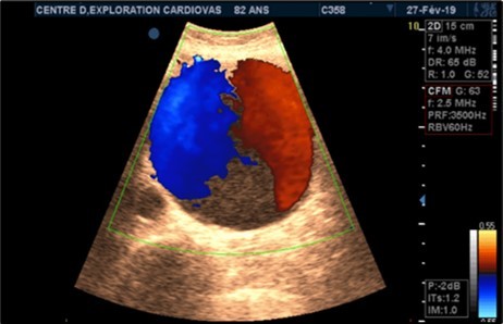 Large fusiform subrenal abdominal    aortic aneurysm of 9.28cm thrombosed at 4/5 in an 82-year-old woman (CEC ‘Saint-Esprit’ from AMP-MCV).