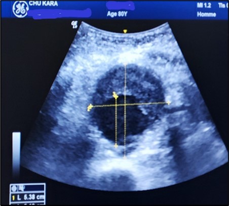 Subrenal AAA of 5.38 cm partially thrombosed in half in an 80-year-old subject (CHU-Kara).