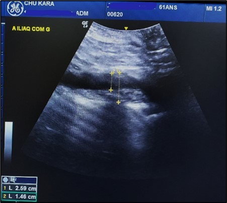 AAA extension with extension to the common iliac artery in a 61-year-old patient (CHU-Kara)