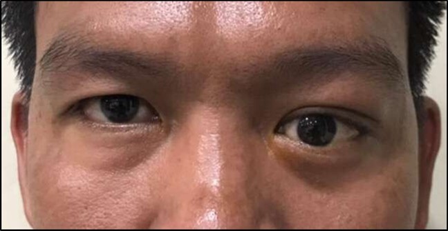 Periorbital inspection showing fullness of the left upper eyelid with inferomedial displacement of the left eye