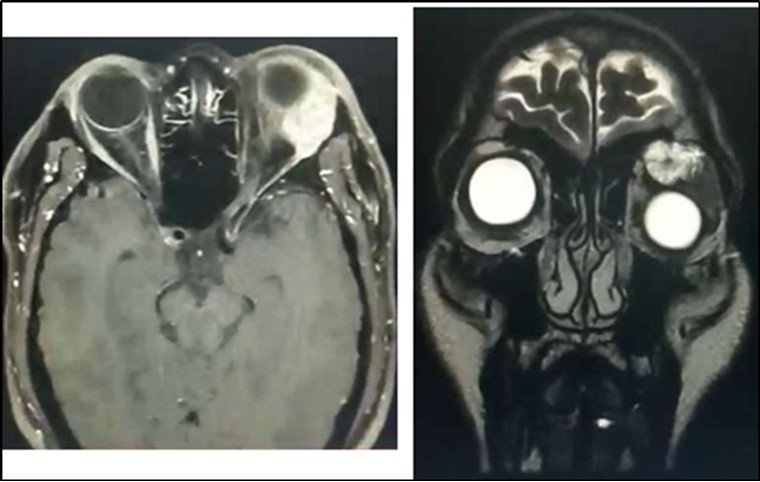 Orbital MRI showing an enhancing lacrimal gland mass (Axial & Coronal Views), left