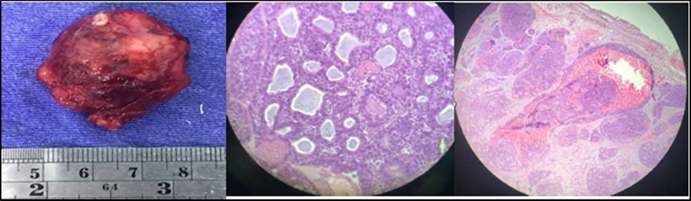 Orbital Mass, left 4B. Cribriform or Swiss-Cheese Pattern 4C. Lymphovascular and perineural            invasion