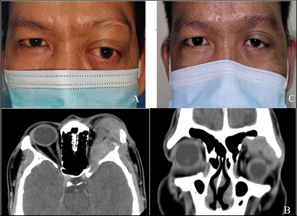 Patient seen two years after the first orbitotomy and tumor excision, with recurrence of mass in the superotemporal orbit and globe displacement. B. Orbital CT scan (axial and coronal sections) revealed a 2.2 x 2.4 x 3.3 cm lobulated, heterogeneously enhancing soft tissue mass seen centered in the left lacrimal gland with few punctate calcifications and associated lytic changes of  the adjacent left frontal bone that are suggestive of tumor recurrence C. Four months post-op after repeat orbitotomy and debulking of tumor with chemotherapy