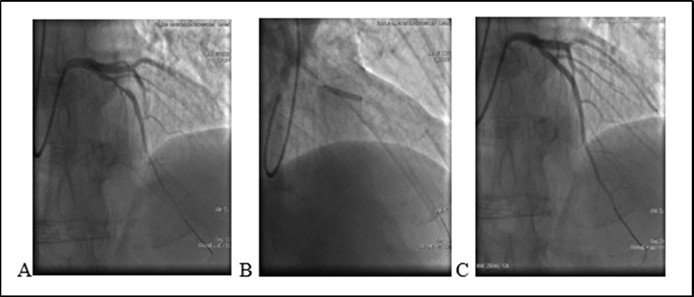 (08.06.2020) A. Medial stenosis in LAD. B. Stent implantation. C. Final result