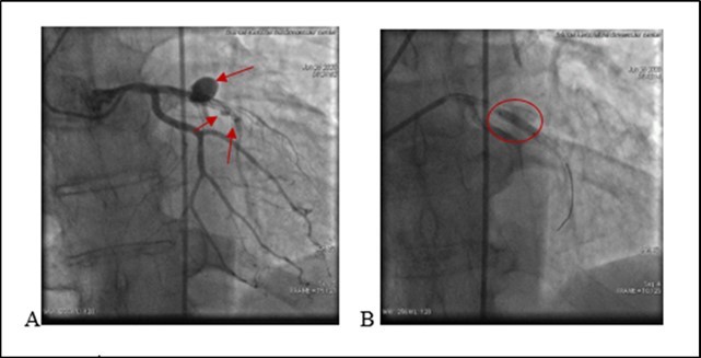 A. (21.06.2020) Second acute stent thrombosis and perforation Type III and II (red arrows) B. Balloon inflation in the site of rupture (red circle).