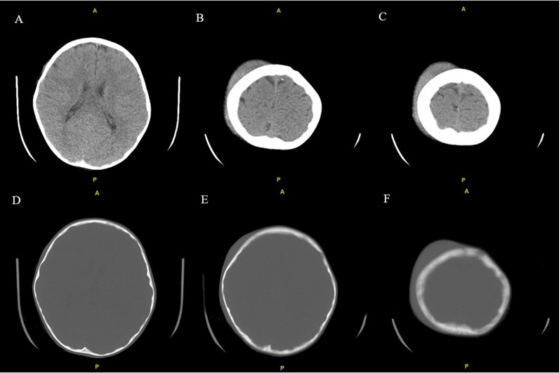 Noncontrast CT examination of the brain. Multiple axial images were obtained. Images listed from superior to inferior.  Adjustment of the MA and/or KV was done according to the patient's size. Findings include right high convexity scalp soft tissue swelling without acute intracranial abnormality.