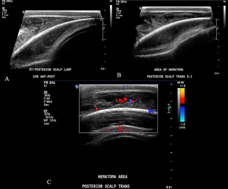 Ultrasound soft tissue head using multiplanar gray scale and color Doppler images. The superficial subcutaneous soft tissue appears homogeneous and uniform thickness. There is a layer of heterogeneous               echogenicity deep to the subcutaneous layer, on the surface of the bone which appears retained by an echogenic capsule or membrane. This measures up to 9 mm greatest thickness. The size of the collection is greater than the transducer can measure. Additional images performed to include the edges of the hemorrhage show uplifting of the galea consistent with subgaleal location. The cranial sutures are not adequately included.