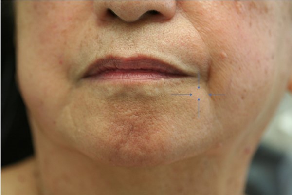 Clinical photograph of subtle mass on left cheek (arrows) that appeared to be a dermoid cyst.