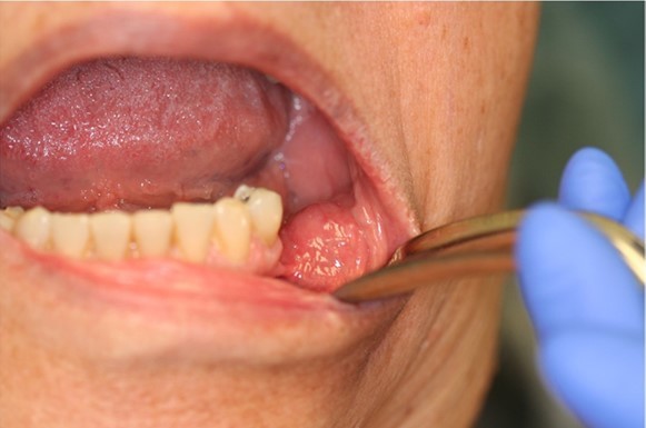 Intraoral photograph of mass in left buccal mucosa of cheek. Note the normal pink color overlying the mass.