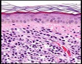 Cutaneous mastocytosis enunciating aggregates of atypical, spherical mast cells incorporated with abundant, eosinophilic cytoplasm, few basophilic granules and enlarged pale nuclei. The mast cell infiltrate is commingled with reactive inflammatory cells and vascular articulations. Stratified squamous epithelium is superimposed upon accumulated mast cells(9).