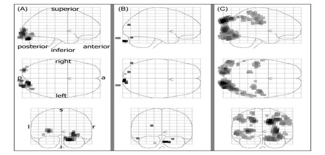 Result of stimulation 3. The black areas denote active brain regions (P<0.05). (A) Condition 1. Activations was detected in bilaterally primary visual cortex. (B) Condition 2. Activations was not detected in primary visual cortex. (C) Condition 3. Activations was not detected in primary visual cortex.