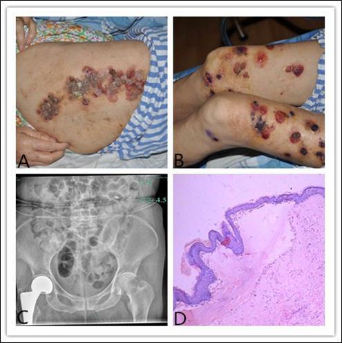 (A) Erythema and blisters on the skin of the right thigh. (B) Multiple tense vesicles, bullae and blood blister on the legs on a background of erythema. (C) The right hip prosthesis made of titanium alloy can be seen by the computed tomography scanning.  (D) Histopathology revealed a subepidermal blister (haematoxylin and eosin staining, original magnification x 100).