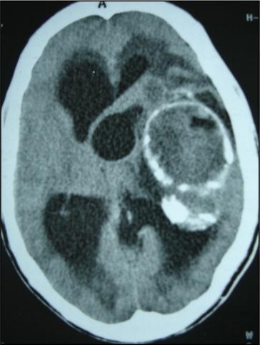 axial CT showing another cyst located in thalamic region