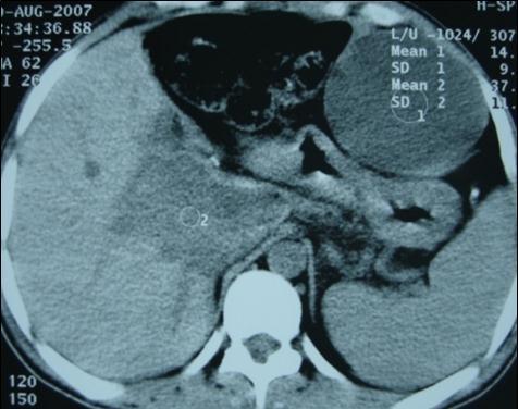 Abdominal CT scan showing intraperitoneal hydatid cysts