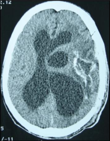 post operative CT scan showing the residual capsule.