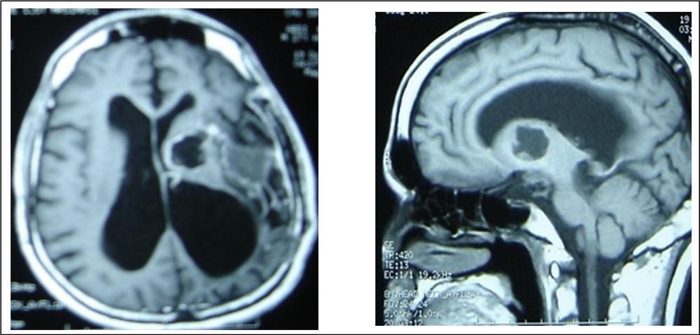 sagittal and axial T1 C+ MRI showing the residual capsule and deep cyst.