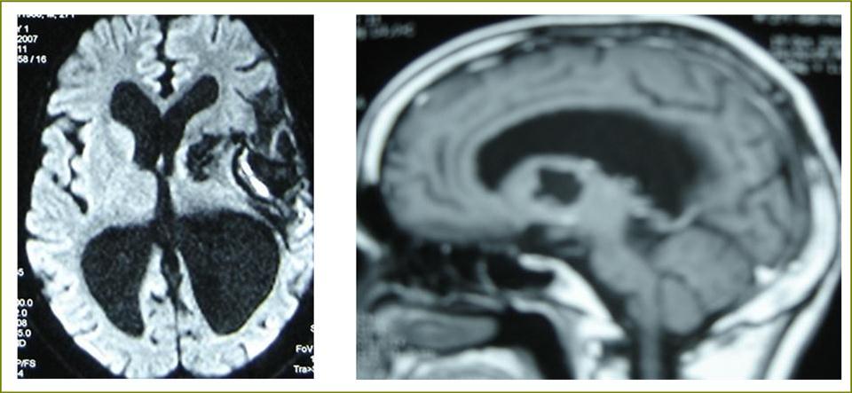 sagittal T1 C+ MRI and axial spectroscopy  showing the residual capsule and deep cyst which is less spherical.