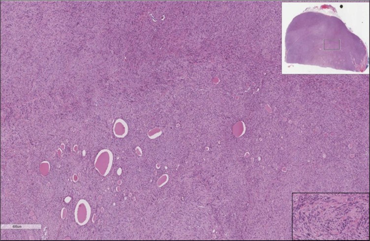 Left thyroid On a Higher power, few thyroid follicles are noted and the lesion is composed of spindle cells with sweeping fascicles (H&E, ×200).