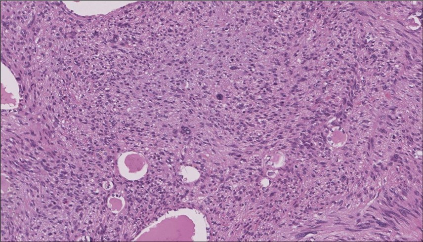 Left thyroid The malignant looking cells are showing diffuse atypia, mitosis and hyper-chromatic nuclei, some remaining follicles could be noted as well (H&E, ×400).