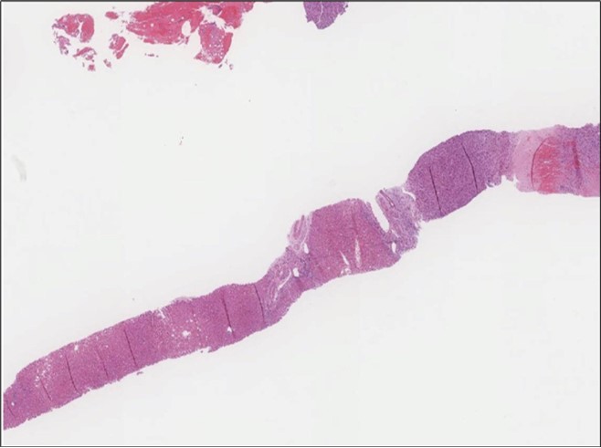 Liver biopsy Lower power of the liver core showing normal liver and part of the metastatic foci (H&E, x4)