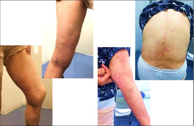 Swelling of body, 21 days after CAC