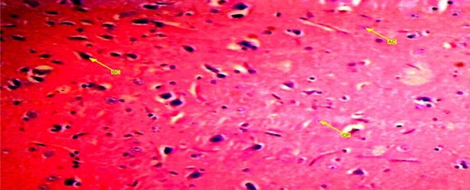 Showed a photomicrograph of anterior pituitary gland of female wister rat treated with progesterone pills for 72 days. It causes decrease in                acidophilic and basophilic cells compared with control group. Chomophobes are also in less  proportion compared with control group.