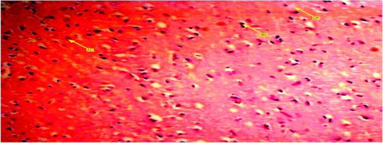 Showed a photomicrograph of anterior pituitary gland of female wister rat treated with combined pills for 72 days. It causes decrease in acidophilic and                         basophilic cells compared with control group. Chomophobes are also in less proportion compared with control group. Those in this group tend to have more decreased cells.