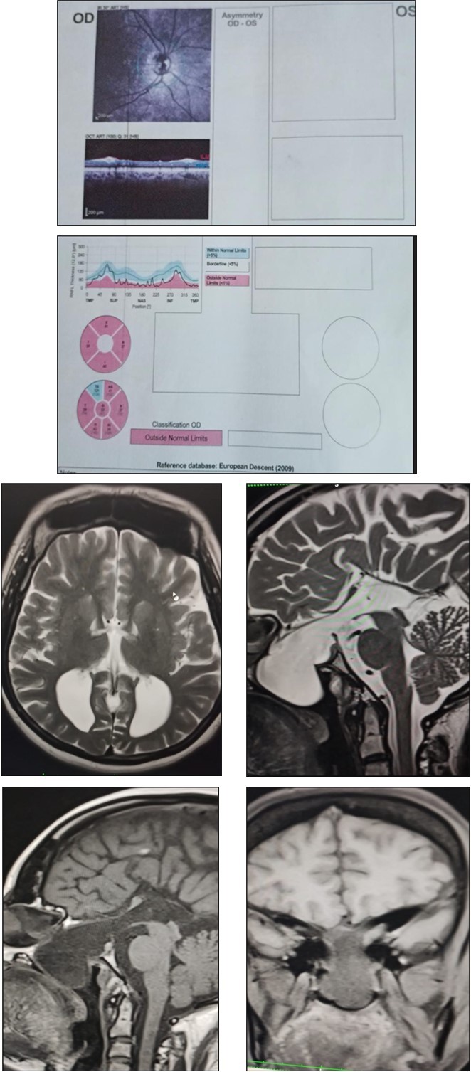Fundus Images and OCT – right optic atrophy ; pale optic disc