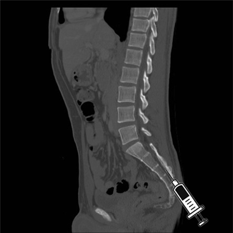 sagittal C.T. scan view of the injection in the hiatus.