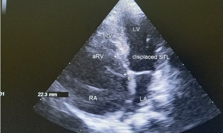 Transthoracic echocardiography, apical four chambers view . Apical displacement of the tricuspid valve (a) and right atrial thrombus (b).
