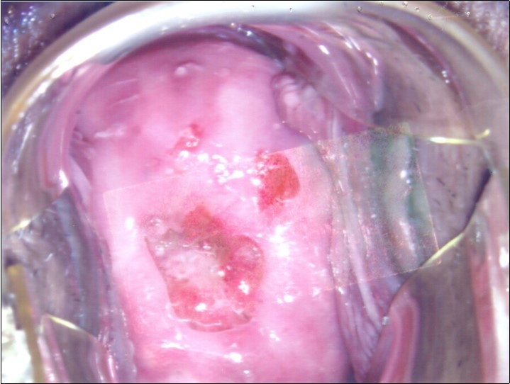 Repeat colposcopy (low magnification)