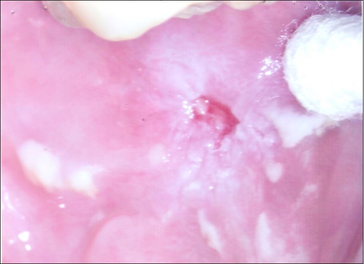 Left buccal lesion