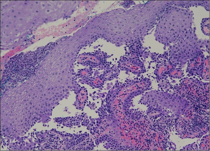Cervical tissue showing intraepidermal and supra-basal blister formation.