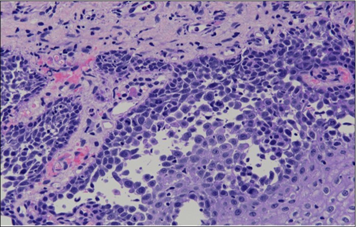 Prominent acantholysis identified
