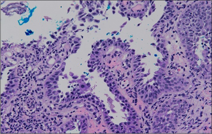 Well vascularised dermal papillae with residual basal layer giving rise to tombstone appearance