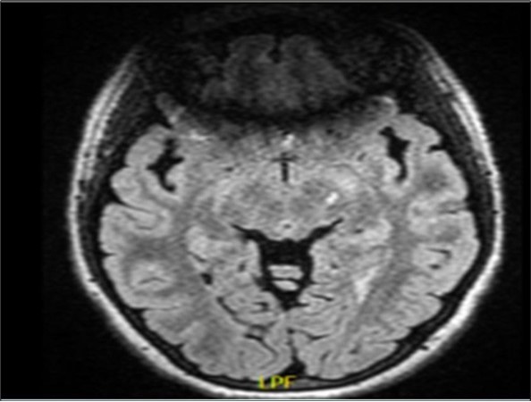 showing a left midbrain demyelinating lesion on a fluid attenuated inversion recovery (FLAIR) image. To note, there is an artifact anteriorly because of the presence of teeth orthodontics.