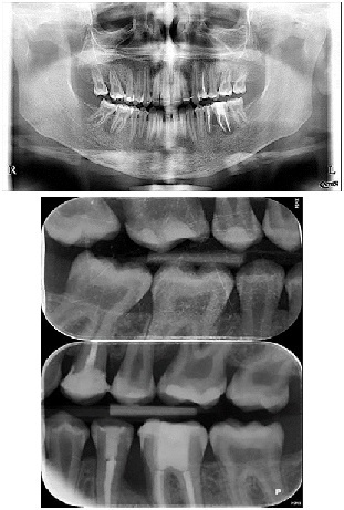 1 and 2 show a wide pulp chamber, root canals, and several restorations.