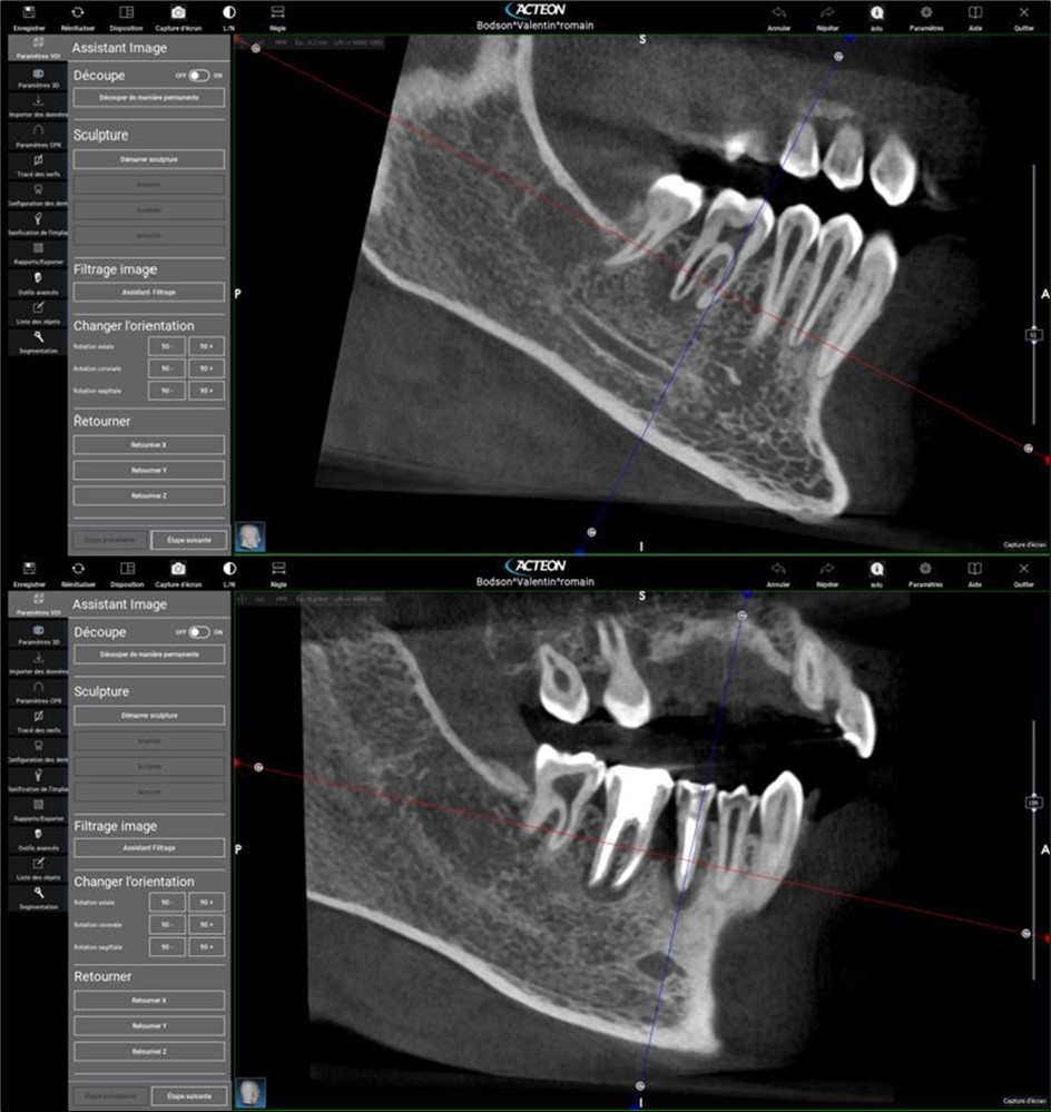 2. 3, 4, and 5 show periapical lesions on teeth 15, 16, 24, 25, 26, 35, 36, and 46.