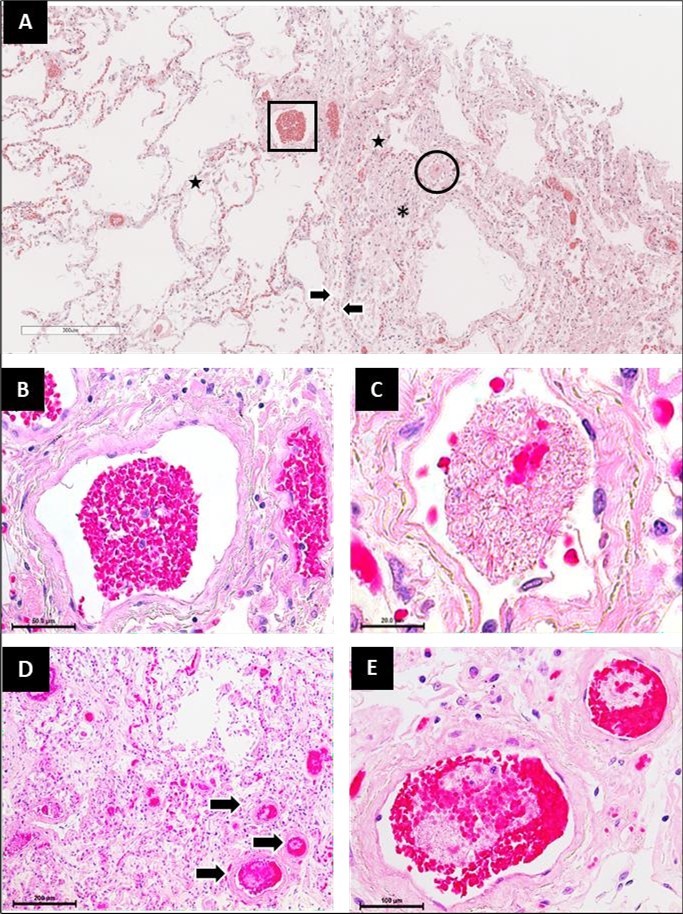 Fibrin thrombi in areas of minimal and severe damage in the lungs of patients who died of SARS-CoV-2 infection. (A) Panoramic micrograph showing a patchy pattern with areas of minimal (left) and severe (right) damage, separated by the interlobular septum (arrows). The square highlights a normal blood vessel (left), while the circle highlights a blood vessel with a fibrin embolus (right). Stars indicate alveolar spaces                   containing alveolar macrophages and pneumocyte detachment. The asterisk indicates areas of inflammatory infiltrate and interstitial thickening. (B, C) Magnification of the blood vessels highlighted in A. (D) Micrograph showing multiple blood vessels containing fibrin emboli (arrows). (E) Magnification of a vessel revealing the structure of a fibrin embolus. Hematoxylin and eosin staining. Magnifications: A panoramic micrograph was obtained using an Aperio CS2-Digital Pathology Slide Scanner. B, 40x; C, 100x; D, 10x; E, 40x.