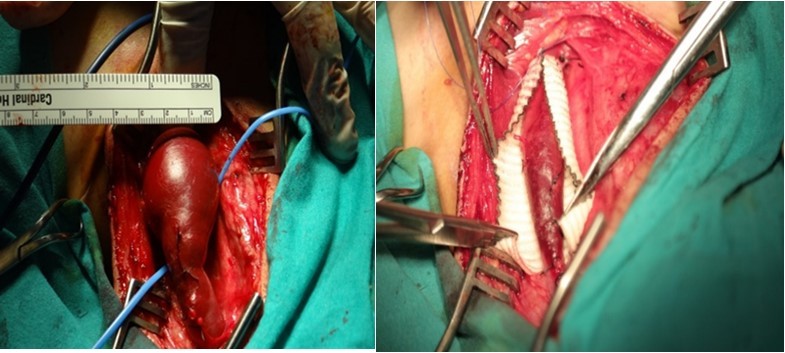 (f) intraoperative photograph shows a fusiform compressible dilatation IJVP. (g)  intraoperative photograph shows the left vein wrapped in Dacron tube graft.
