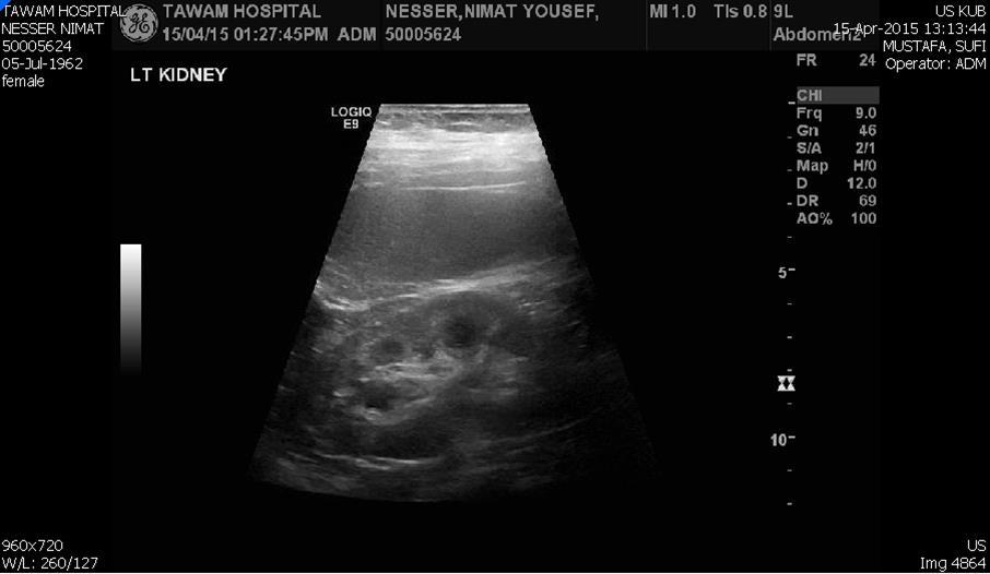 Left kidney hydronephrosis