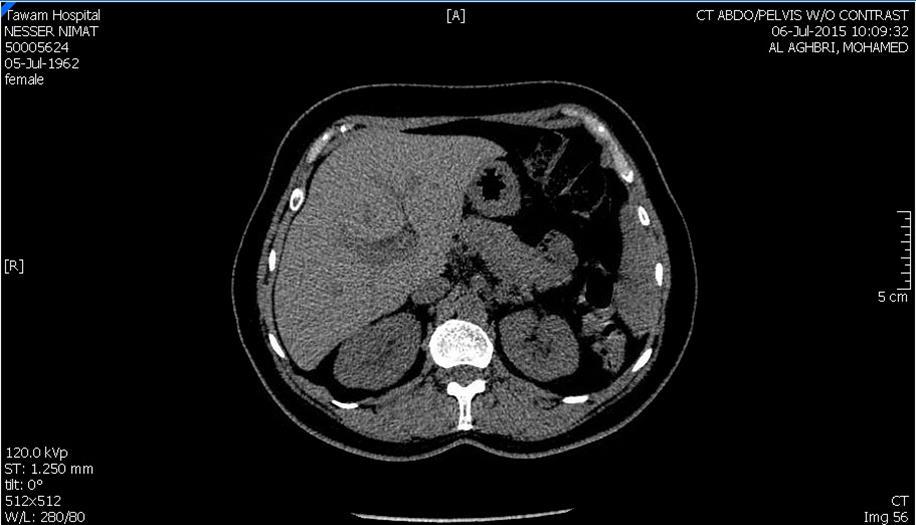 CT Scan showing bilateral kidneys with no hydronephrosis