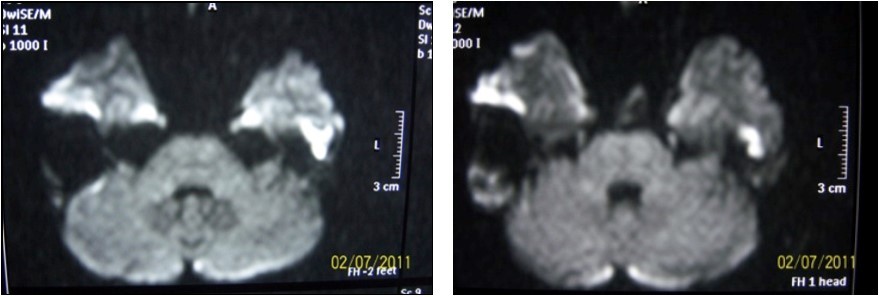 Diffusion MRI image of cholesteatoma