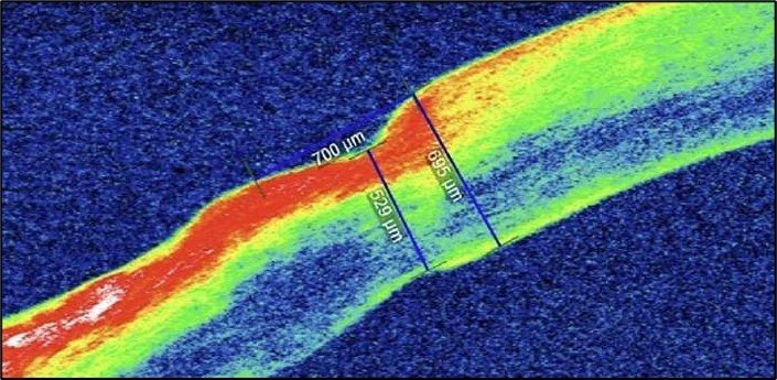 (1-month post conjunctival resection): There is evidence of stromal remodeling with near-complete epithelial regeneration. The ulcer margins appear smoother, and stromal reflectivity is reduced, indicating diminished inflammation. The transition between the ulcerated and normal cornea is more gradual, consistent with active healing and fibrotic repair.