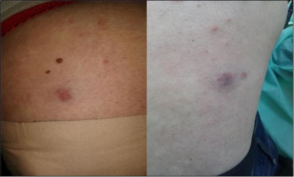 Erythematous-to-violaceous, edematous, inflammatory, and tender papules and plaques on both thighs