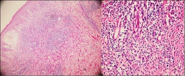 (a) Edema in papillary dermis, a superficial and deep perivascular and periadnexal lymphocytic infiltrate(H&E X100) (b) intense perivascular lymphocytic infiltrate and edema on vessel walls(H&E X200)