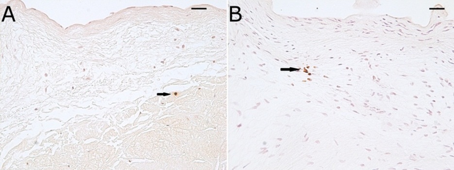 Photomicrographs of Runx2 immunohistochemistry of a normal (A) and myxomatous (B) mitral valve demonstrating minimal staining for Runx2. Scale bars = 25 μm.